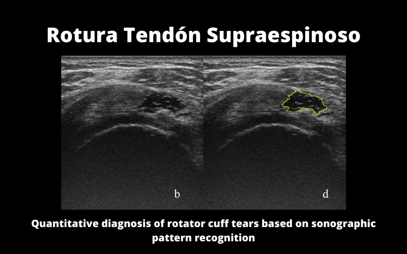 Rotura Tendon Supraespinoso.png